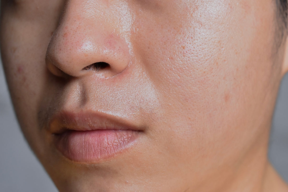 Oily skin with wide pores in face of adult young woman in closeup view