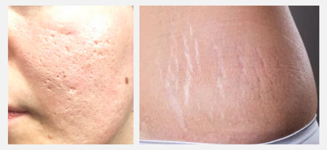 Scratch Scars From Razor Scars: How They Form, and How to Tream Them – Jamila